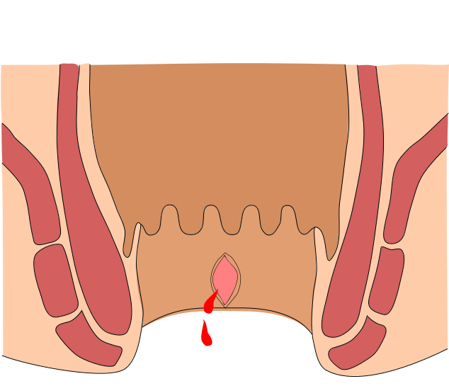 裂肛(切れ痔)