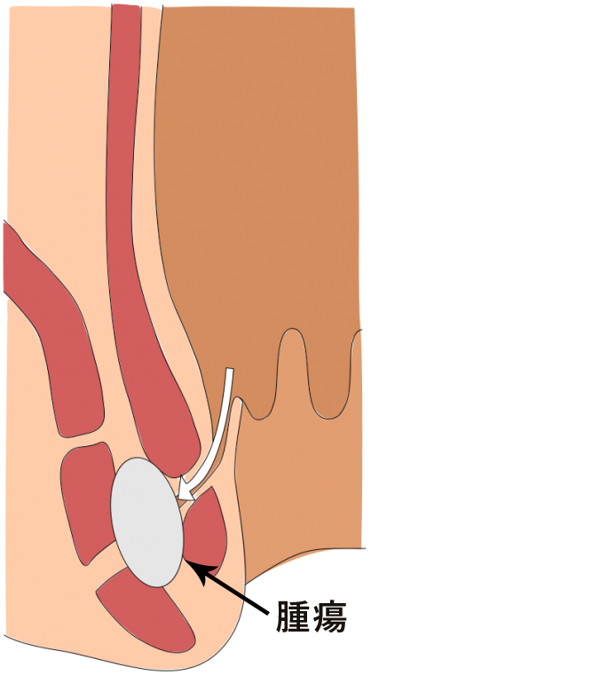 肛門周囲膿瘍