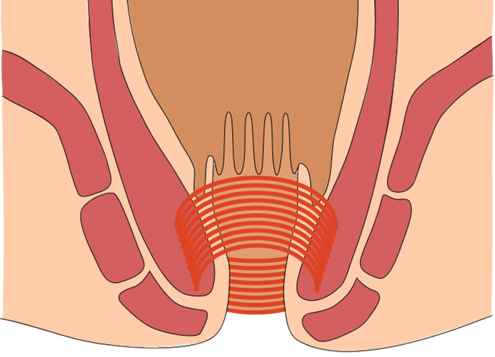 肛門管をぐるりと取り囲んでいる内括約筋の一部を切って、肛門を拡げます。