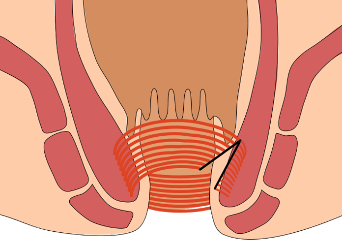 内括約筋の一部を切るとお尻の穴が拡がります。
