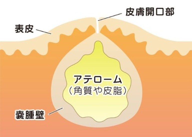 大阪市鶴見区で粉瘤・脂肪腫などの皮下腫瘤摘出をしている服部クリニック